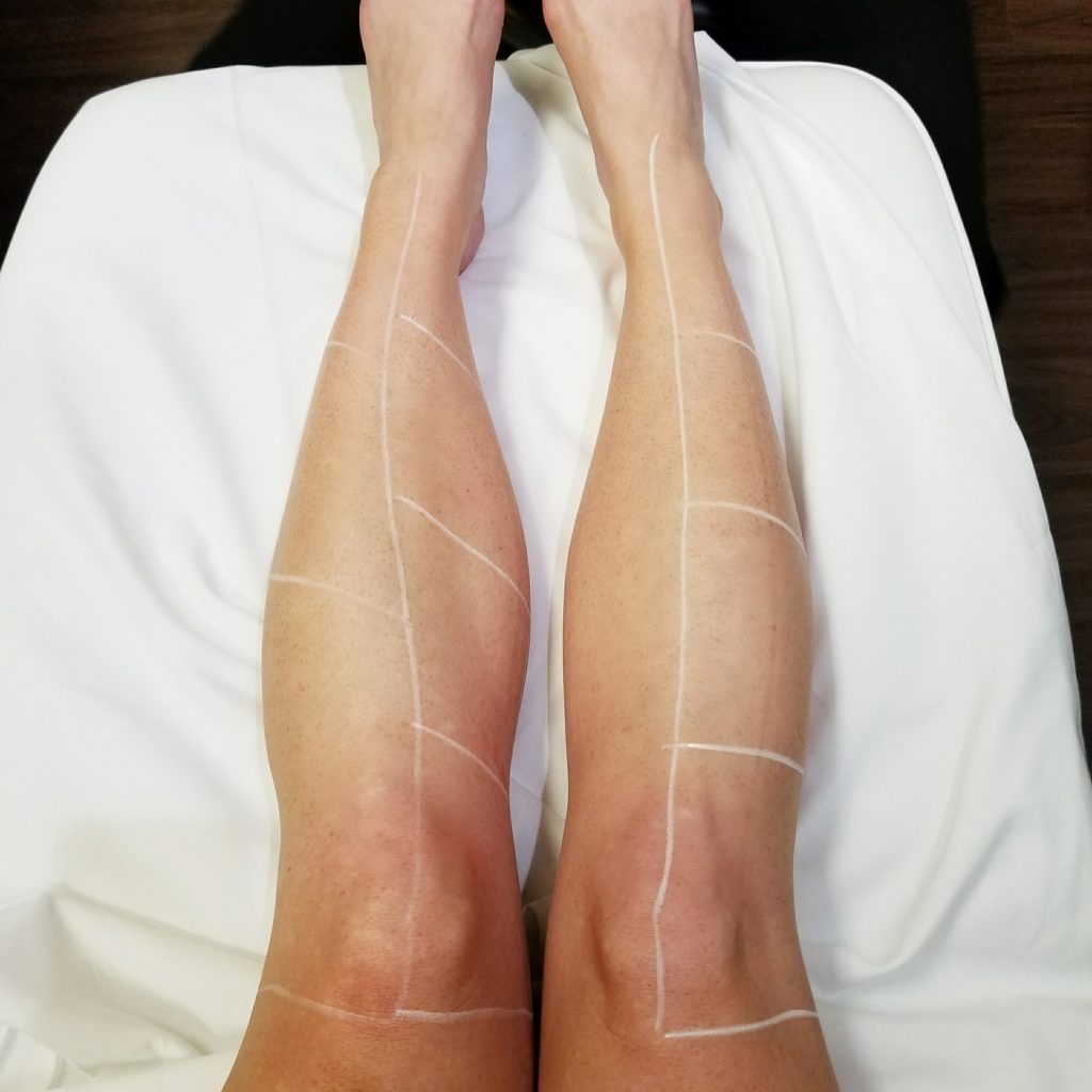 Extra LSR My Experience with Laser Hair Removal. Le Stylo Rouge